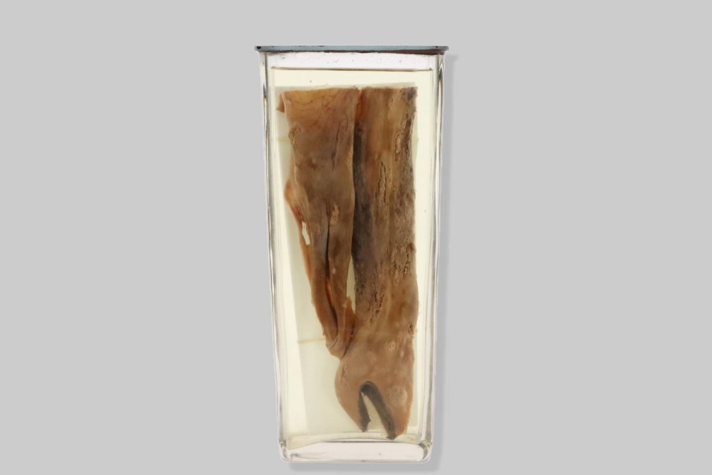 Rhinitis ulcerosa malleosa septi nasi et labiorum equi
