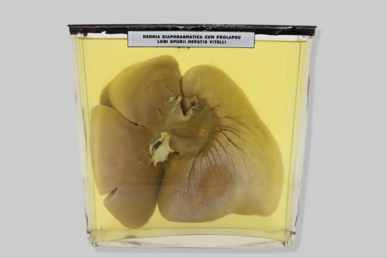 Hernia diaphragmatica cum prolapsu lobi spurii hepatis vitelli