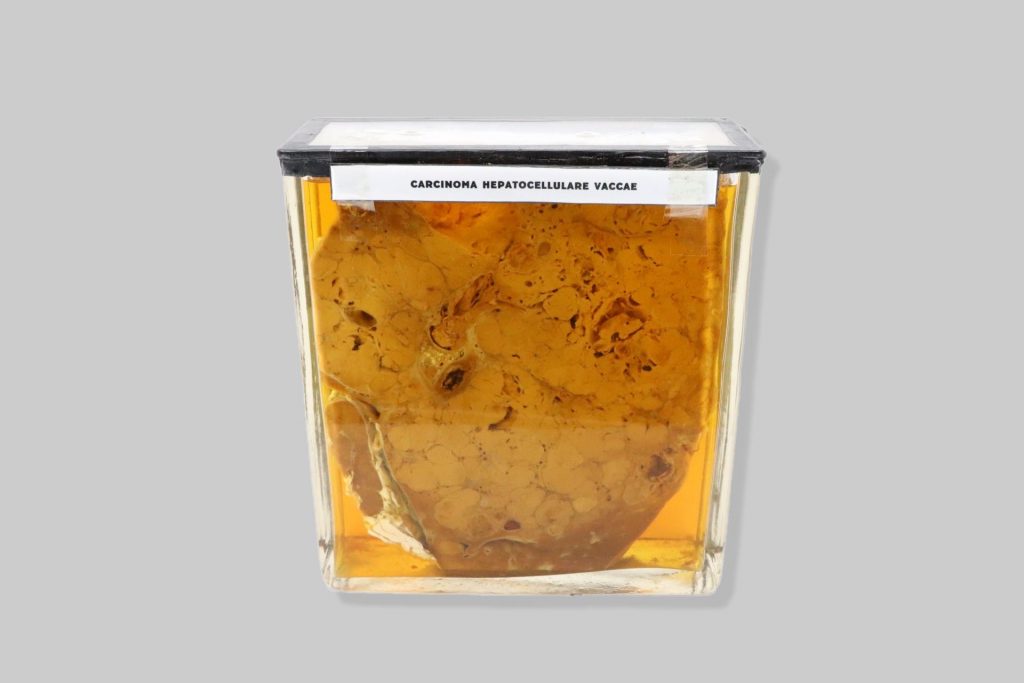 Carcinoma hepatocellulare vaccae
