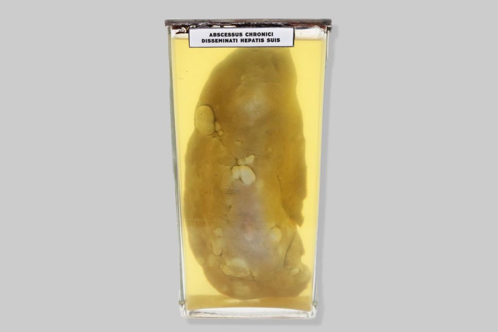 Abscessus chronici disseminati hepatis suis