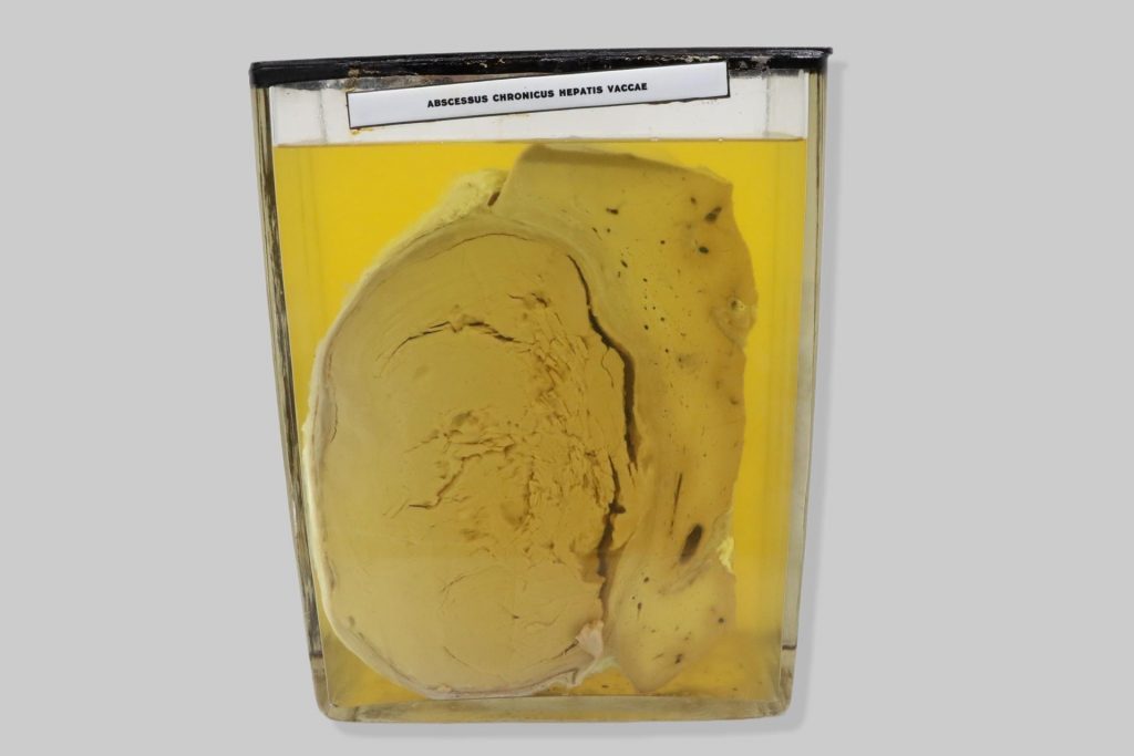 Abscessus chronicus hepatis vaccae