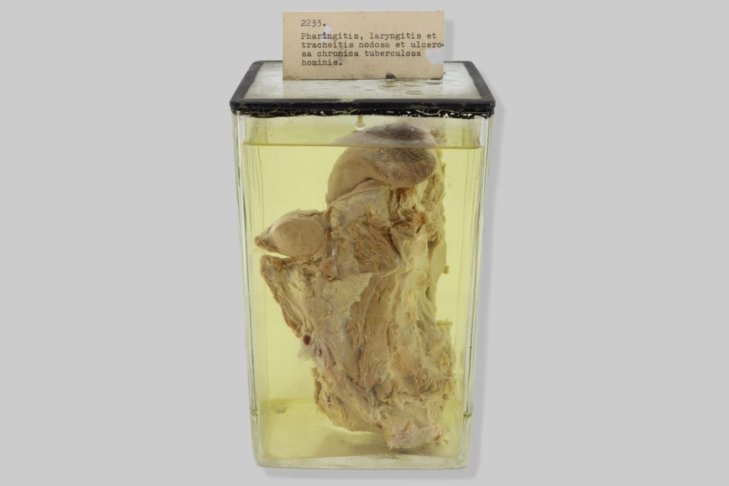 Pharyngitis, laryngitis et tracheitis nodosa et ulcerosa chronica tuberculosa hominis