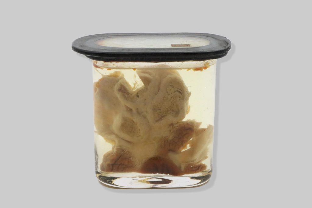 Carcinoma medullare necroticans partis glandularis ventriculi gallinae