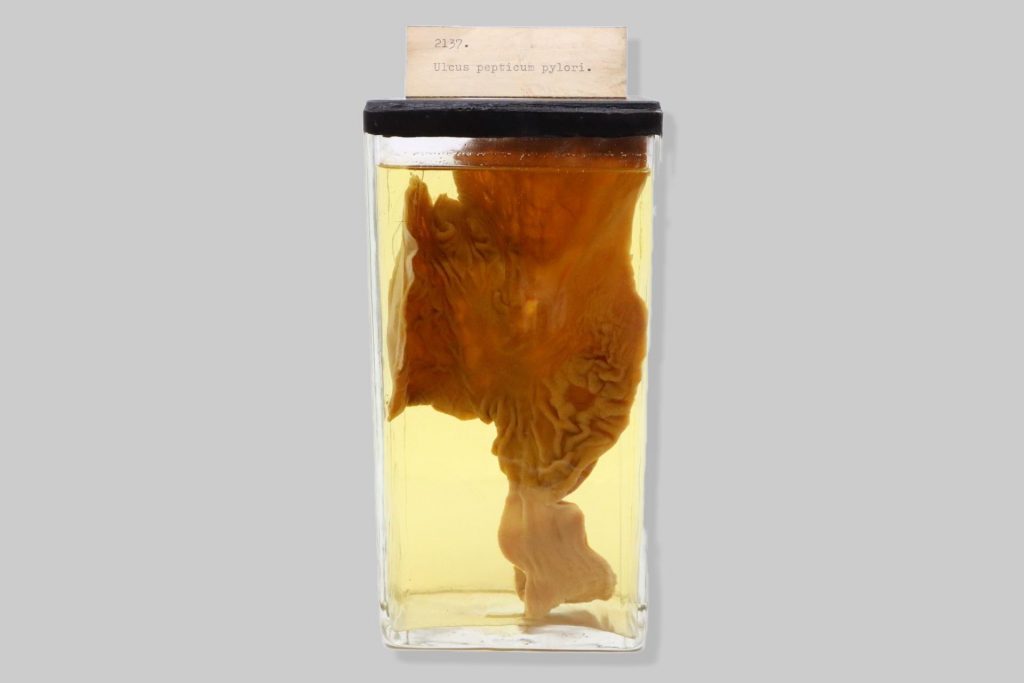 Ulcus pepticum ventriculi chronicum partis praepyloricae cum adhesione omenti et lobi lateralis dextri hepatis subsequentae abscessibus multiplicibus hepatis canis