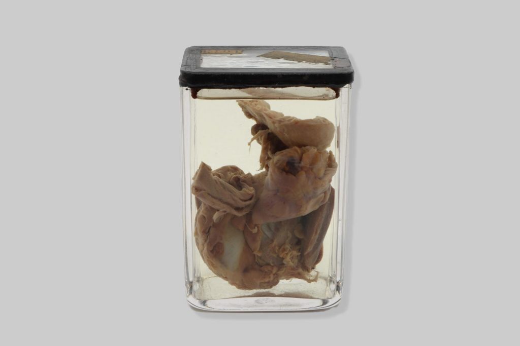 Sarcoma haematolymphoblasticum ventriculi partis glandularis et myocardii gallinae