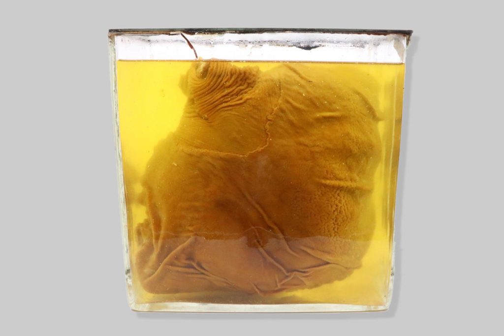 Ulcus pepticum perforans duodeni suis