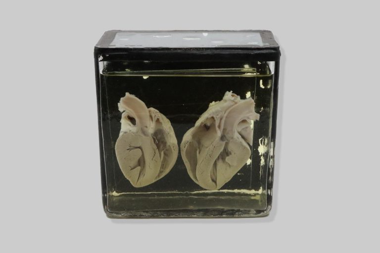 Hypertrophia myocardii ventriculi sinistri cordis