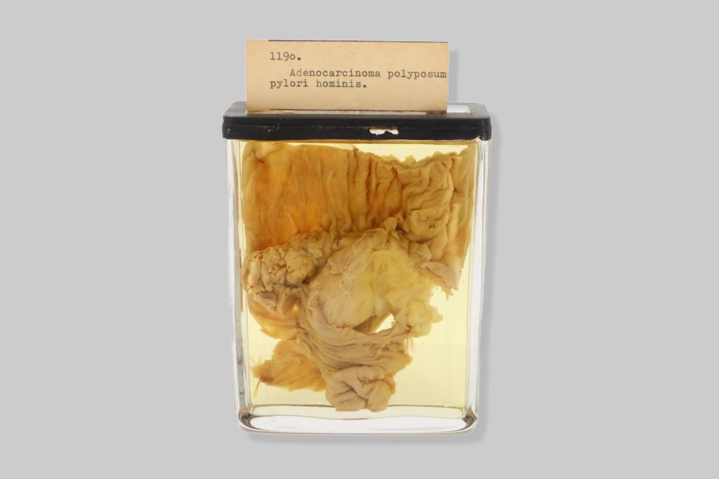 Adenocarcinoma polyposum pylori hominis