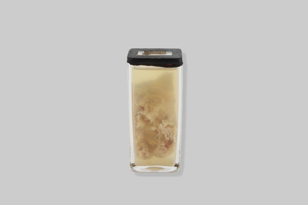 Adenocarcinoma mucinosum valvulae ileocoecalis hominis