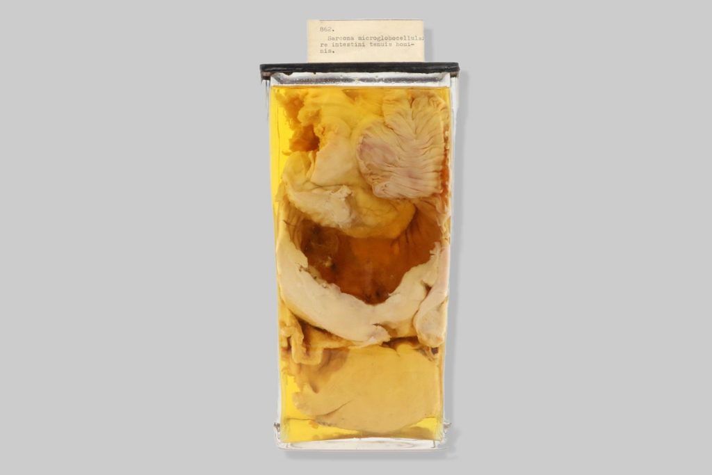 Sarcoma microglobocellulare intestini tenuis hominis