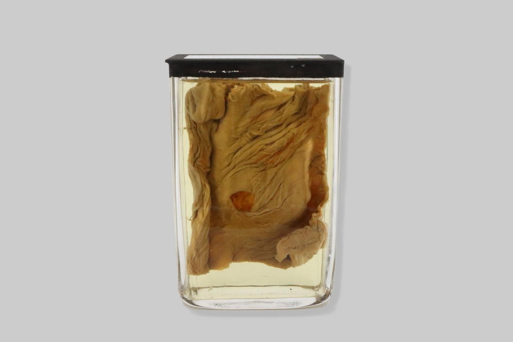 Diverticula multiplicia intestini colonis hominis