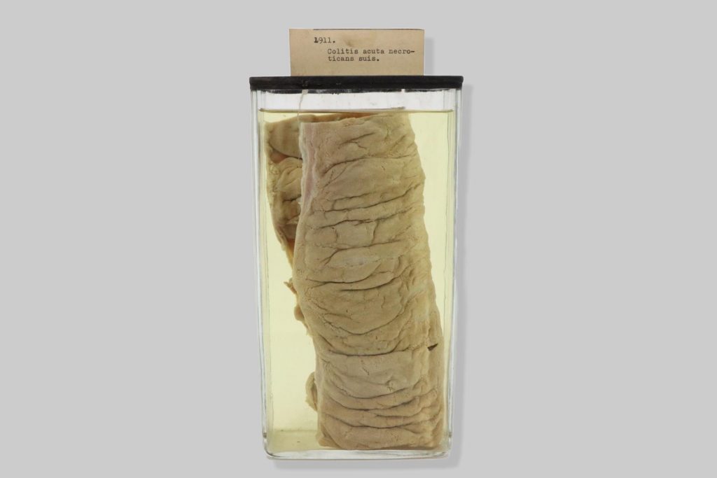Diverticulum intestini coeci
