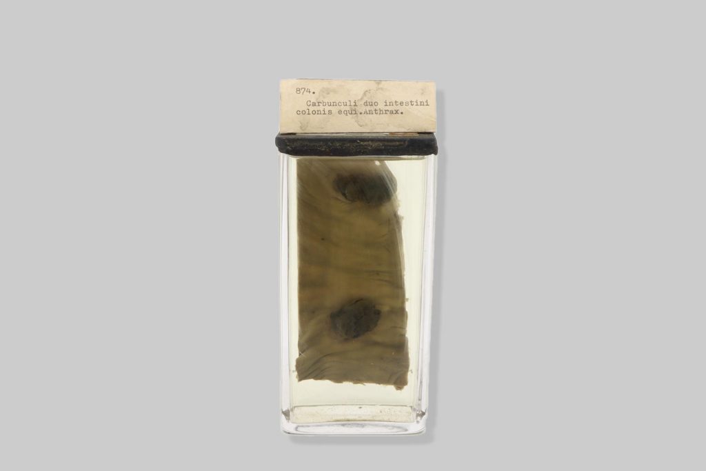 Intumenscentia medullaris et necroses intestini hominis. Typhus abdominalis.