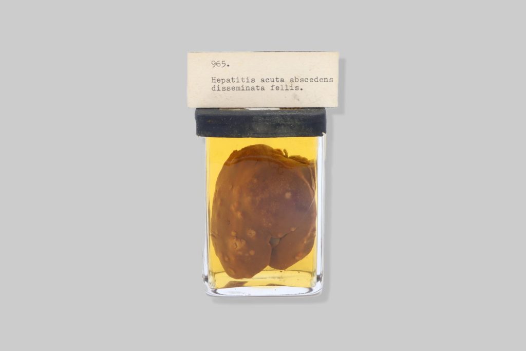 Haematoma subcapsulare chronicum hepatis equi.