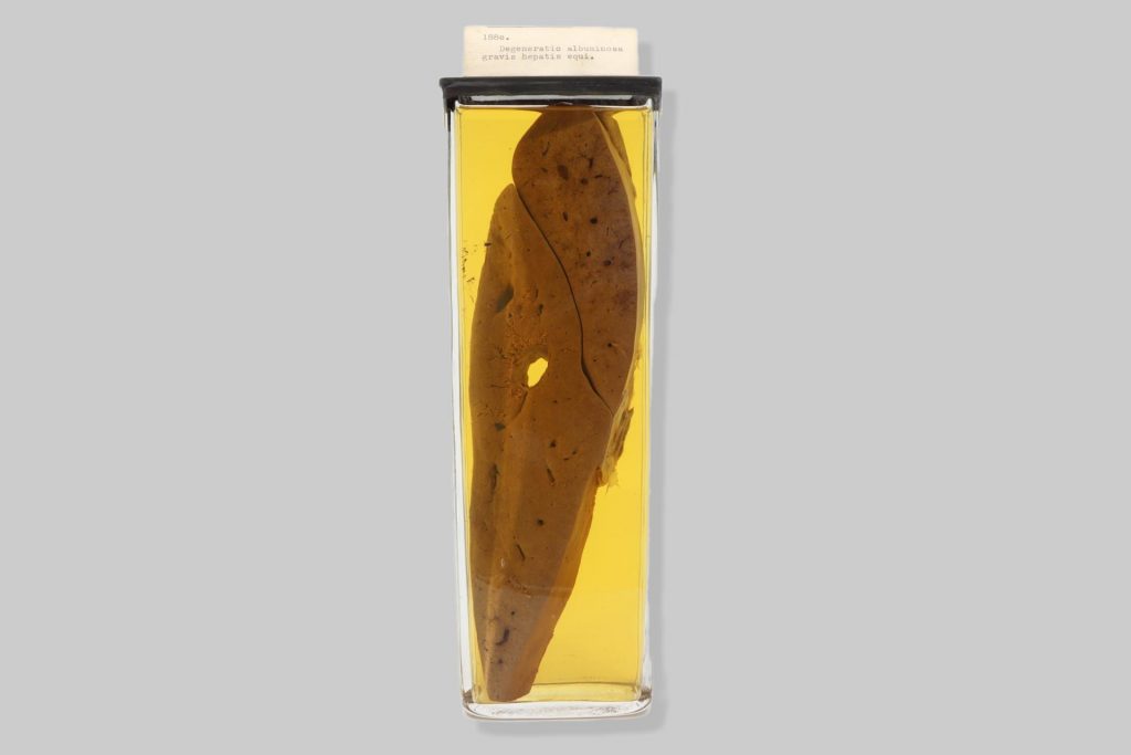 Cirrhosis et carcinoma solidum simplex hepatis hominis