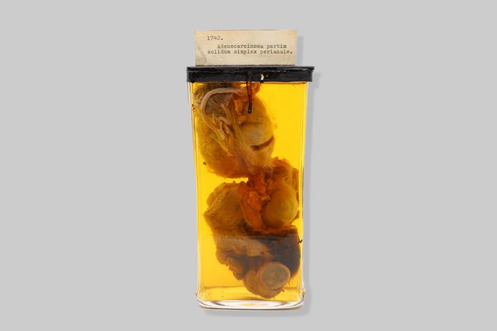 Adenocarcinoma partim solidum simplex perianale