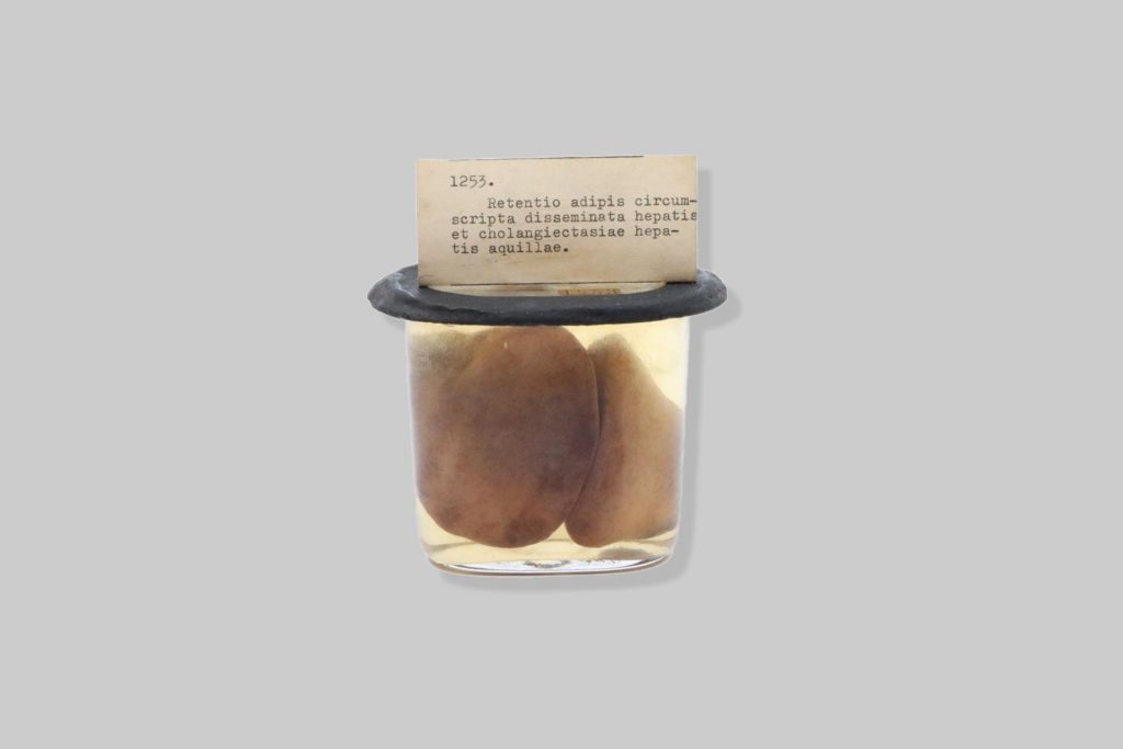 Retentio adipis circumscripta disseminata hepatis et cholangiectasiae hepatis aquillae