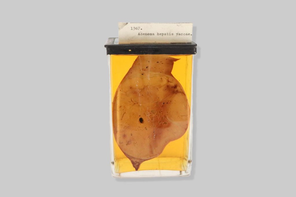 Adenoma hepatis vaccae