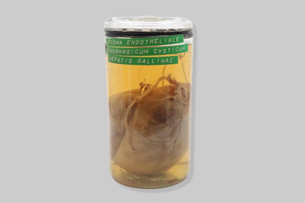 Sarcoma endotheliale haemorrhagicum cysticum hepatis gallinae