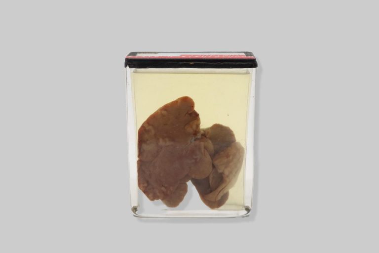 Coccidiosis hepatis cuniculi