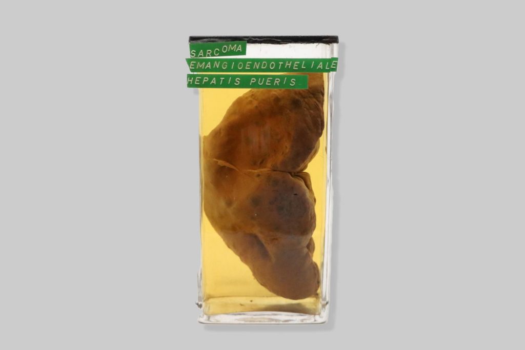 Sarcoma haemangioendotheliale hepatis pueris