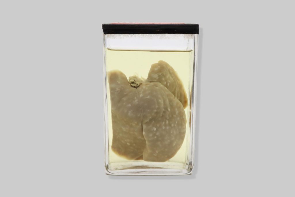 Coccidiosis hepatis cuniculi