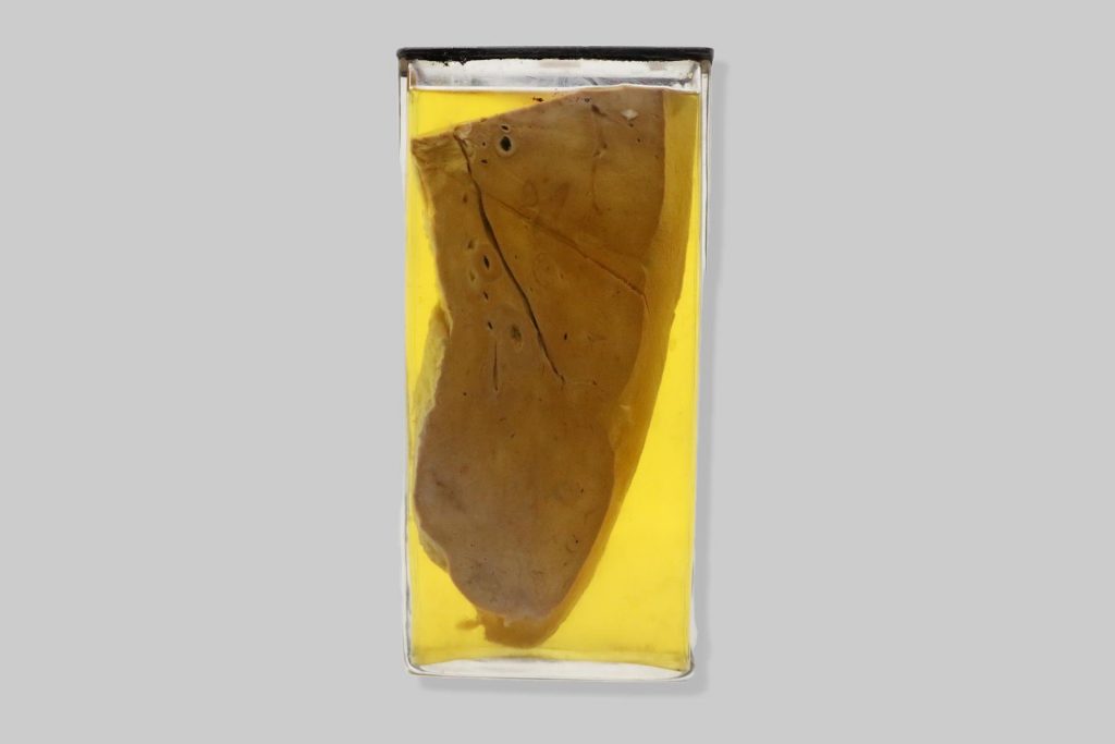Actinomycosis hepatis vaccae