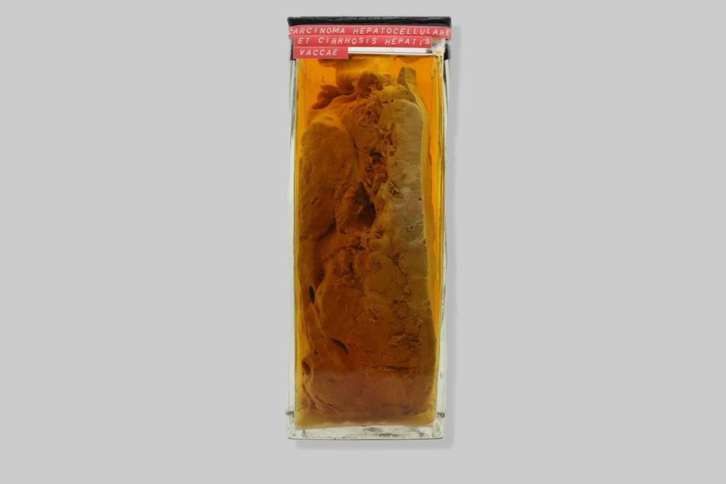 Carcinoma hepatocellulare et cirrhosis hepatis vaccae