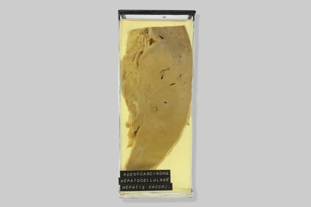 Adenocarcinoma hepatocellulare hepatis vaccae