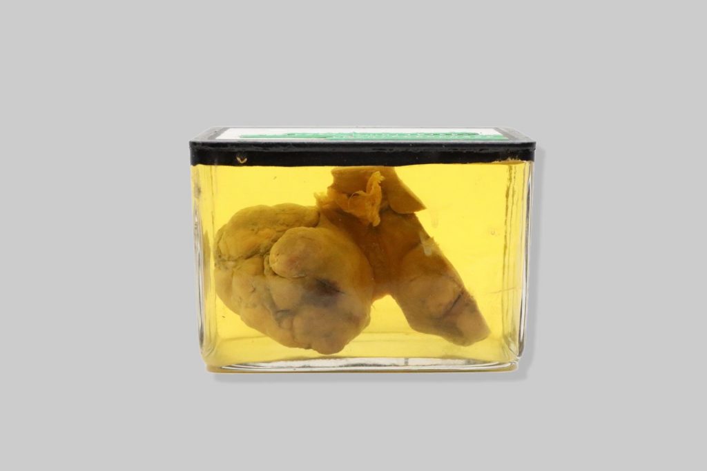 Adenocarcinoma metastaticum hepatis et mamma felis