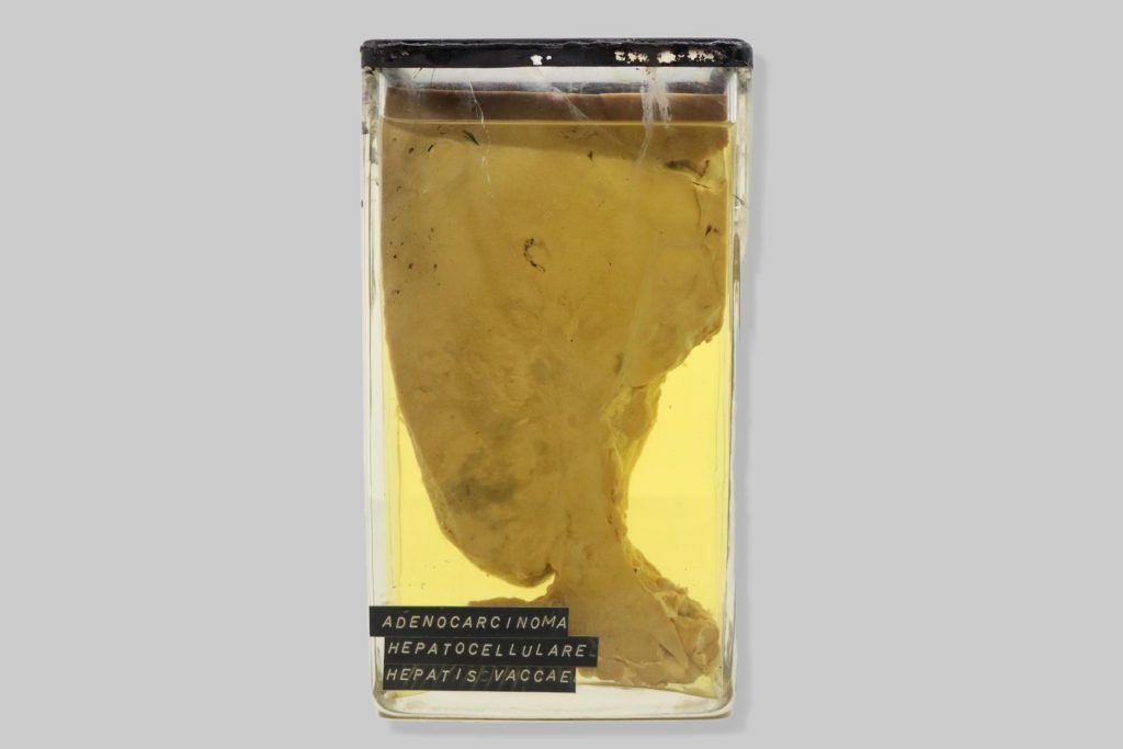 Adenocarcinoma hepatocellulare vaccae