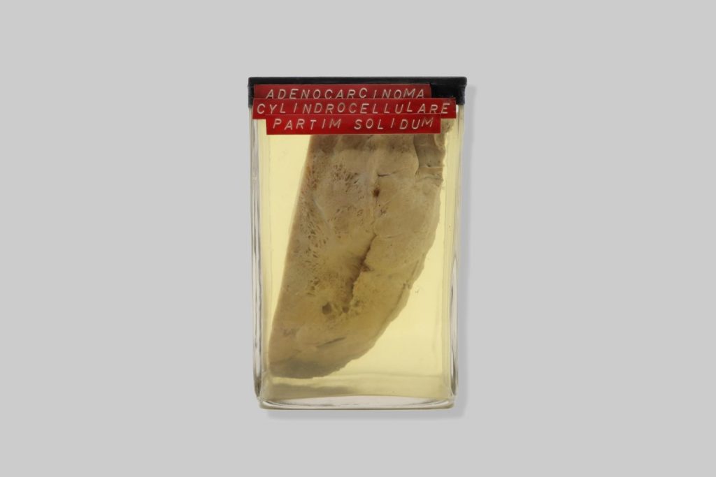 Adenocarcinoma cylindrocellulare partim solidum