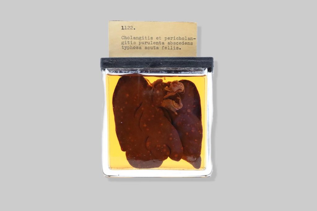 Cholangitis et pericholangitis purulenta abscedens typhosa acuta fellis