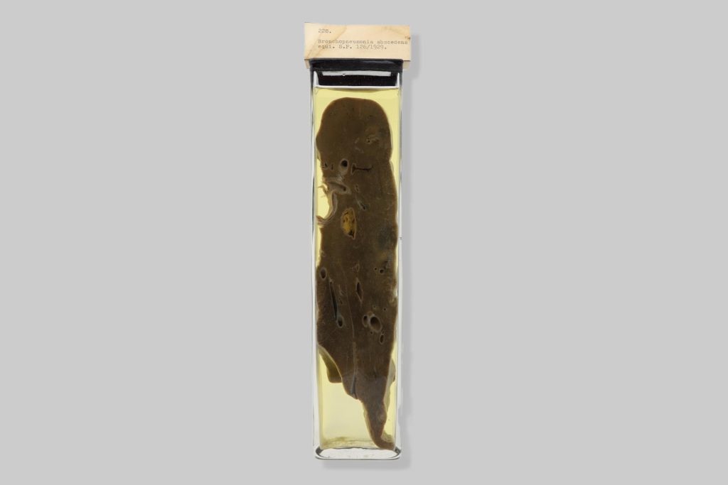 Bronchopneumonia abscedens equi