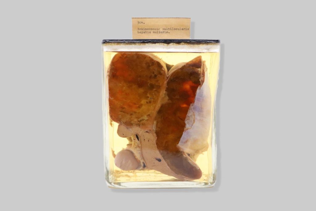 Echinococcus multilocularis hepatis mulieris
