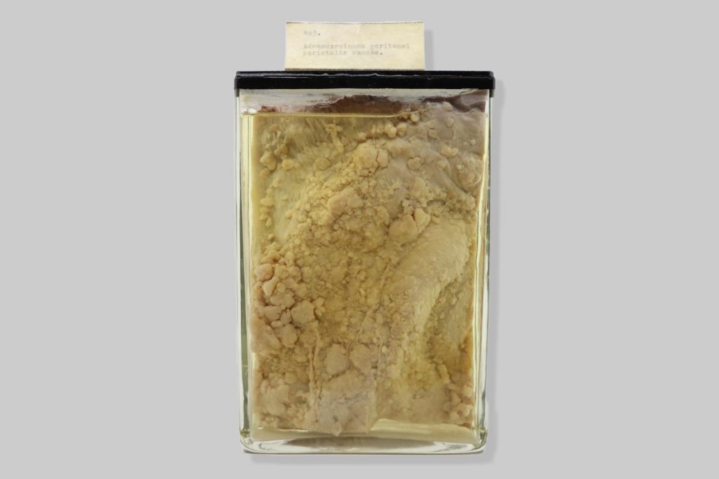 Adenocarcinoma peritonei parietalis vaccae