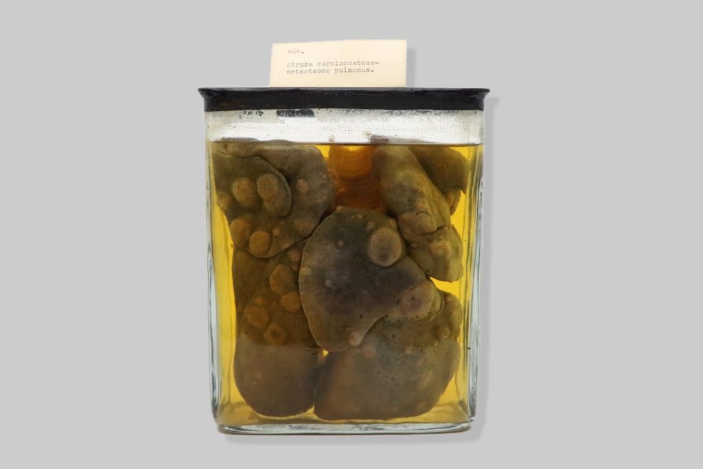 Struma carcinomatosa- metastases pulmonum