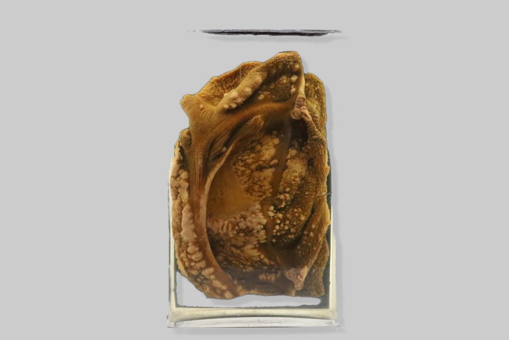 Ruminitis actinomycotica bovis