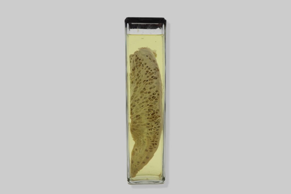 Cysticercosis linguae suis