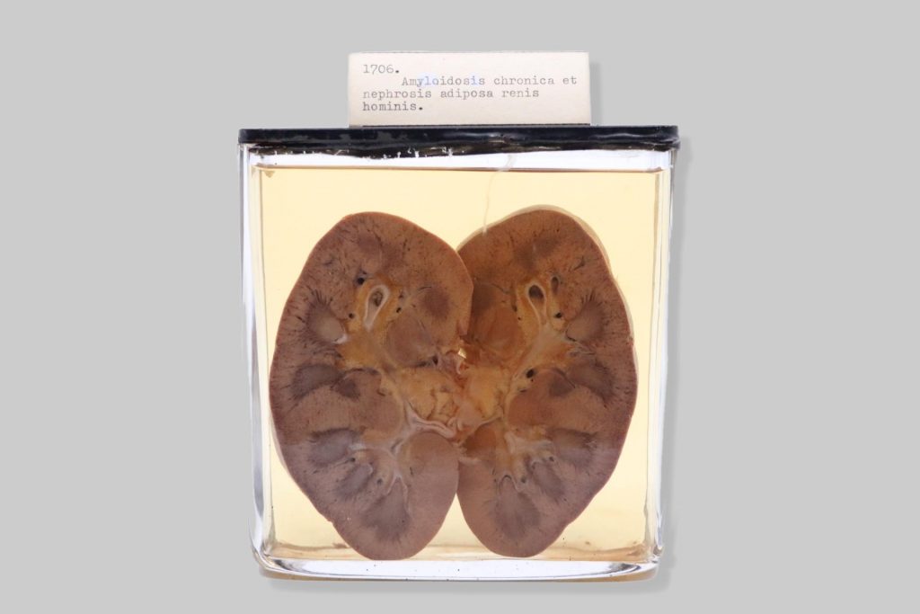 Amyloidosis chronica et nephrosis adiposa renis hominis