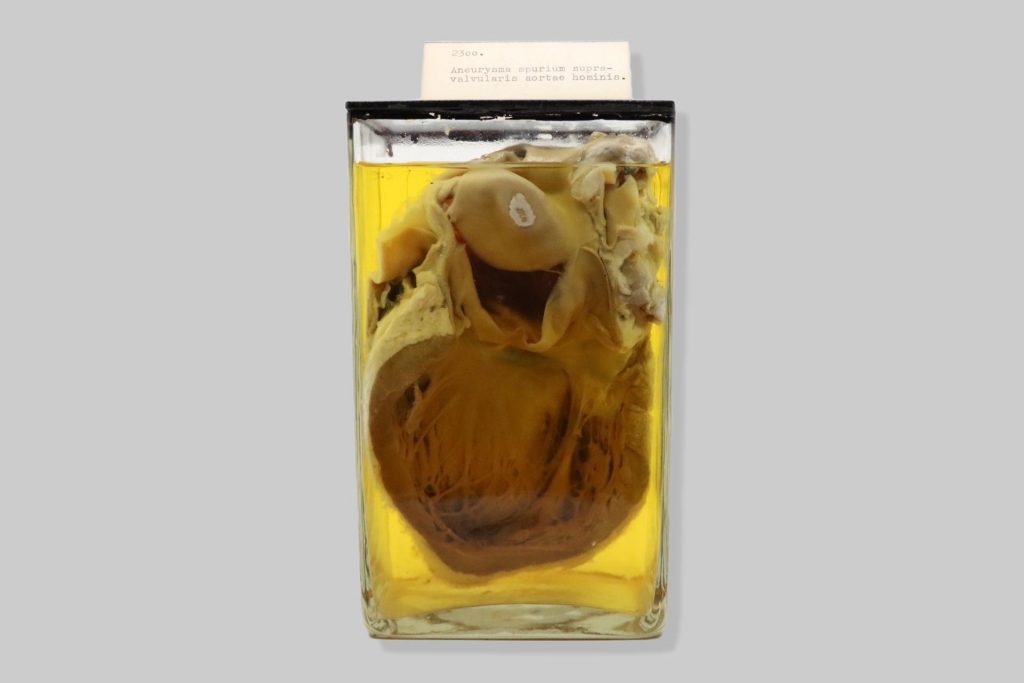Aneurysma spurium supravalvularis aortae hominis