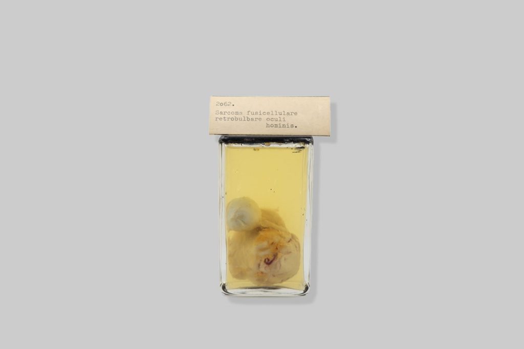 Sarcoma fusicellulare retrobulbare oculi hominis