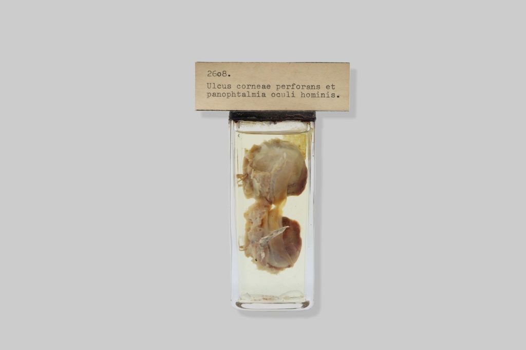 Ulcus corneae perforans et panophtalmia oculi hominis